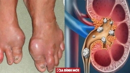 3 biến chứng đáng sợ của bệnh Gout, tuyệt đối không được coi thường kẻo có ngày hối hận