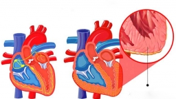 4 biến chứng nguy hiểm của bệnh viêm cơ tim, dấu hiệu nào để nhận biết sớm bệnh?