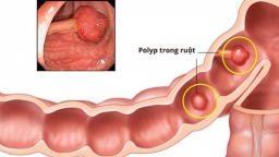 Phát hiện 5 polyp ở đường ruột bé gái 5 tuổi do mắc bệnh hiếm gặp