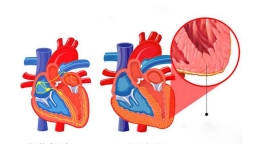 Cô gái trẻ bị viêm cơ tim với nhiều biến chứng phức tạp, 5 dấu hiệu giúp nhận biết sớm