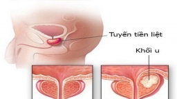 Bị đi tiểu ra máu, người đàn ông đi khám phát hiện ung thư tuyến tiền liệt, làm thế nào để phát hiện sớm bệnh