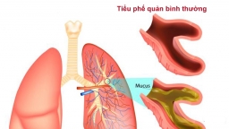 Thời tiết chuyển lạnh, trẻ bị viêm tiểu phế quản gia tăng và những lưu ý cho cha mẹ