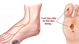 Nhiều người mất chân vì biến chứng của bệnh đái tháo đường