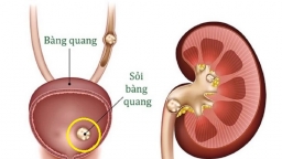 Tiểu buốt, tiểu khó, cụ ông đi khám phát hiện 12 viên sỏi lớn trong bàng quang, 2 thói quen xấu gây ra sỏi bàng quang mà nhiều người đang mắc phải