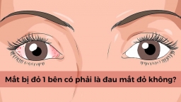 Mắt bị đỏ một bên có phải là đau mắt đỏ không? Có lây sang mắt còn lại không?