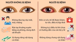 Bị đau mắt đỏ bao lâu thì khỏi? Tất tần tật những điều cần biết về đau mắt đỏ