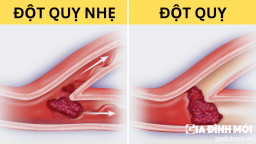 4 triệu chứng cảnh báo cơn đột quỵ nhẹ nhưng không thể chủ quan