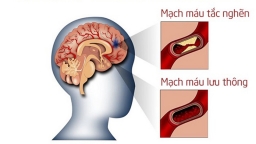 Ai dễ bị đột quỵ nhẹ? Các yếu tố nguy cơ gây đột quỵ nhẹ