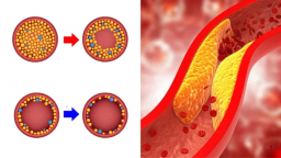 7 thực phẩm tốt nhất để giảm cholesterol xấu, ngăn ngừa đột quỵ