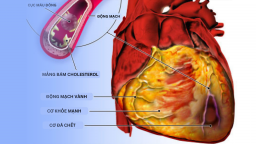 Bác sĩ tim mạch: 5 thói quen xấu khiến trái tim suy yếu, tăng nguy cơ đau tim, đột quỵ