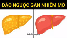 Thực hiện 3 bước sau để 'đảo ngược' bệnh gan nhiễm mỡ