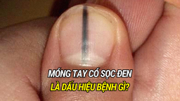 Móng tay có sọc đen là dấu hiệu của bệnh gì?