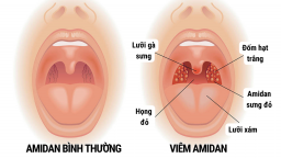 Viêm amidan có thể gây biến chứng nguy hiểm gì, khi nào nên cắt bỏ?