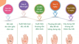 5 dấu hiệu cảnh báo viêm da tiếp xúc do kiến ba khoang