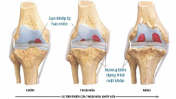 6 yếu tố nguy cơ gây bệnh thoái hóa khớp gối