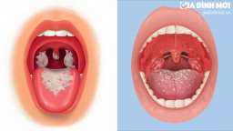 Phân biệt bệnh bạch hầu với viêm họng, amidan