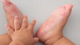 Cảnh báo nguy cơ “dịch chồng dịch”