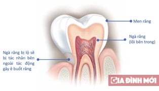 Chỉ dùng kem đánh răng có giảm được ê buốt?