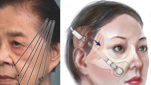 Bệnh viện thẩm mỹ Kangnam, EMCAS có người chết sau làm dịch vụ: Thông tin mới nhất