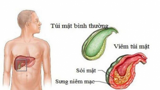 4 lầm tưởng phổ biến về bệnh sỏi mật -  Biết để điều trị hiệu quả 