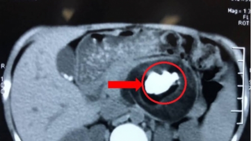 Hy hữu: Khối u chứa tóc, răng, xương hàm nằm trong cơ thể bé gái 7 tuổi