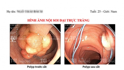 Chàng trai 25 tuổi đã phải mang khối polyp đại tràng khổng lồ