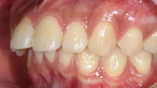 Nụ cười 'lột xác' sau khi niềng răng hô: Chia sẻ từ chủ nhân nụ cười mới