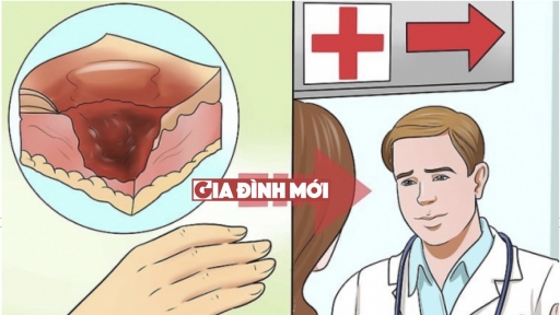 Kỹ năng sơ cứu: Cách sơ cứu khi bị bỏng tại nhà