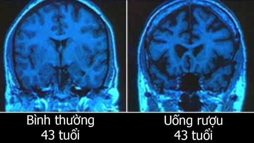 10 thói quen khiến bộ não lão hóa sớm, biết để sửa trước khi quá muộn