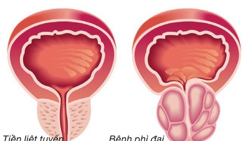 Cứ 2 đàn ông trên 50 tuổi thì có 1 người mắc phì đại tiền liệt tuyến