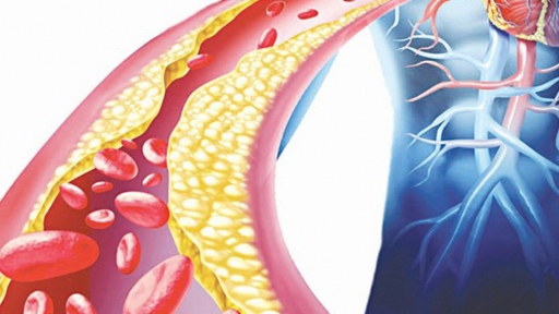 Bệnh tăng cholesterol máu gia đình di truyền khiến bé 9 tuổi phải đặt stent mạch vành