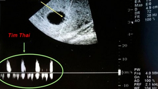 Có bầu mấy tuần có tim thai?
