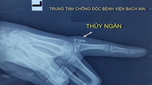 Bé gái 11 tuổi nhiễm độc thủy ngân do bị chọc nhiệt kế thủy ngân vào tay