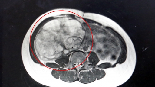 Bé gái 12 tuổi phổng phao, gia đình không nhận thấy bụng to bất thường với khối u khủng
