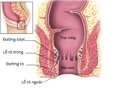 Một người đàn ông đi khám phát hiện 6 lỗ rò quanh hậu môn, hoá ra bệnh này phổ biến sau bệnh trĩ