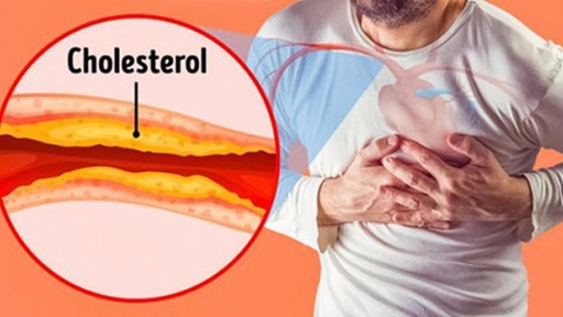 Cholesterol trong máu cao nghĩa là gì? 4 người nguy cơ bị mỡ máu cao