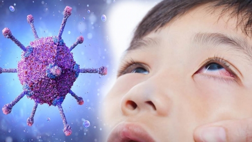 Viêm kết mạc do Adenovirus nguy hiểm thế nào, trẻ có dấu hiệu này cha mẹ cần đưa đi khám ngay