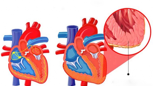 4 biến chứng nguy hiểm của bệnh viêm cơ tim, dấu hiệu nào để nhận biết sớm bệnh?