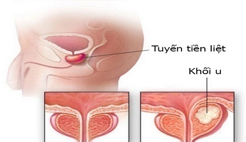 Bị đi tiểu ra máu, người đàn ông đi khám phát hiện ung thư tuyến tiền liệt, làm thế nào để phát hiện sớm bệnh