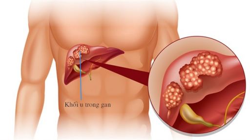 Bất ngờ vỡ u gan, hôn mê sau cơn đau bụng dữ dội