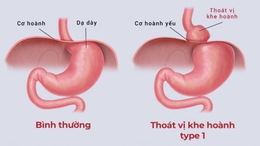 Nuốt nghẹn, ăn uống kém, cụ bà đi khám phát hiện dạ dày ‘chui’ lên ngực