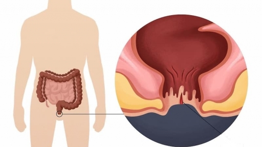 Bị ngứa, rát hậu môn, đi khám phát hiện mắc bệnh mà nhiều người đang mắc