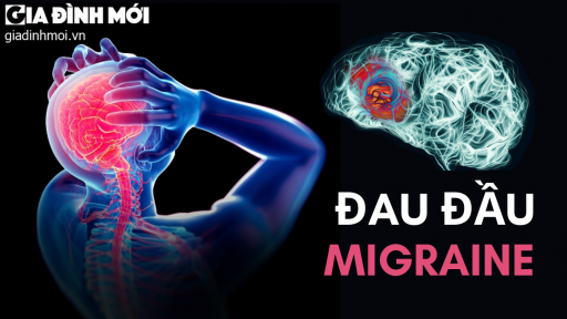 Đau đầu Migraine là gì? Nguyên nhân, biểu hiện, cách điều trị