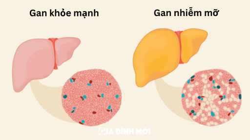 3 biến chứng nguy hiểm từ bệnh gan nhiễm mỡ