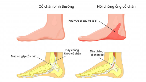 Hội chứng ống cổ chân là gì? Cách điều trị hội chứng ống cổ chân kết hợp Đông - Tây y