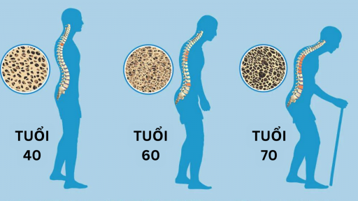 Cảnh báo căn bệnh thầm lặng tấn công hơn 3 triệu người Việt, nhất là phụ nữ trên tuổi 50