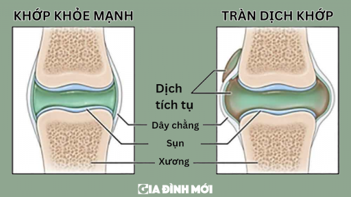 3 dấu hiệu cảnh báo tràn dịch khớp gối, không phát hiện sớm có thể gây tàn phế