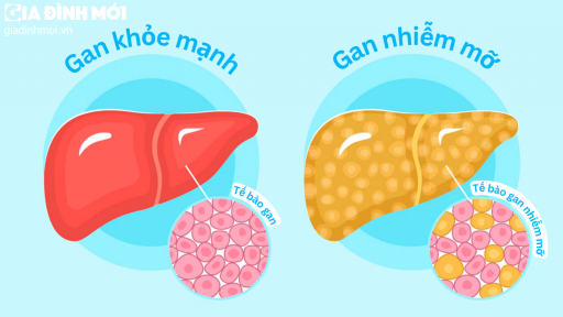 5 dấu hiệu cảnh báo gan nhiễm mỡ, người gầy cũng có thể bị