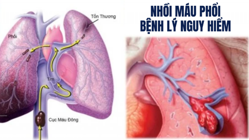 Khó thở, hụt hơi, ho kéo dài: Cảnh báo bệnh lý nhồi máu phổi nguy hiểm