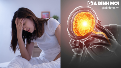 Đau nửa đầu Migraine tiềm ẩn nguy cơ đột quỵ não và những biến chứng nguy hiểm